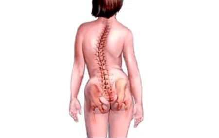 As razóns para o desenvolvemento da osteocondrose do cérvix