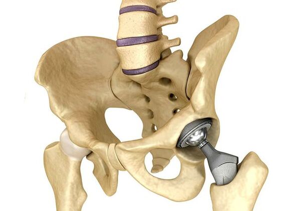 Endoprotésicos da articulación da cadeira