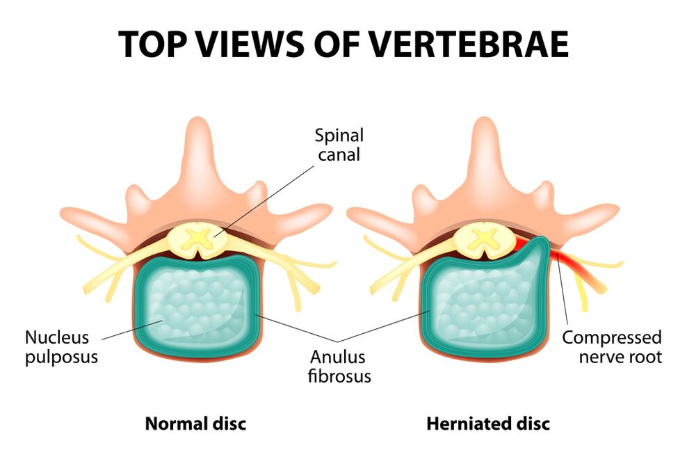 Disco intervertebral saudable e hernia