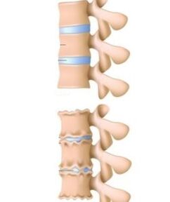 As causas da osteocondrose
