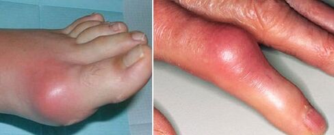 Aparición de articulacións con artrite