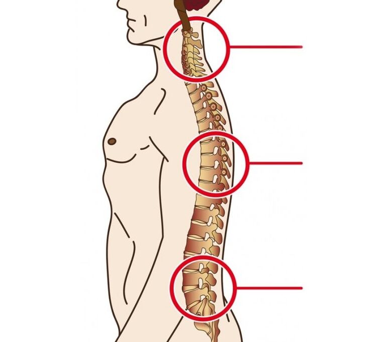 Localización da osteocondrose cervical, torácica e lumbar