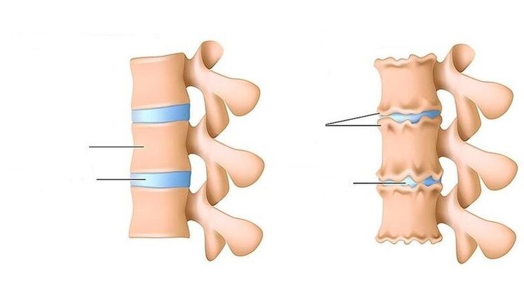 columna vertebral san e afectados pola osteocondrose
