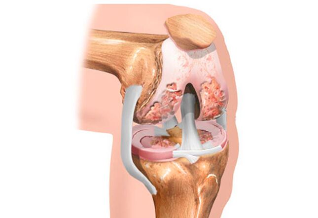 Osteoartrite da articulación do xeonllo