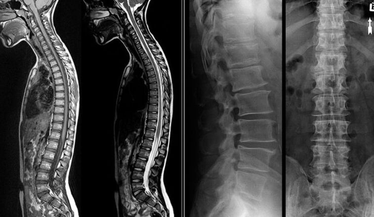 Imaxes de raios X e resonancia magnética en osteocondrose