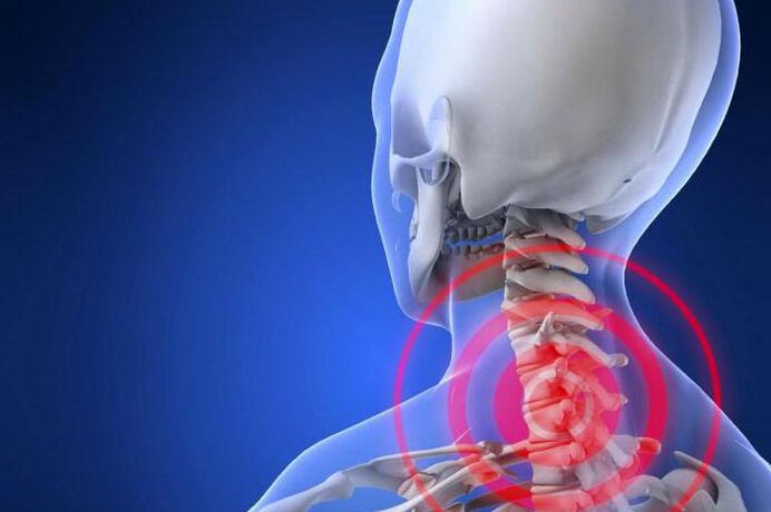 Dor lancinante no pescozo - un síntoma precoz da osteocondrose cervical