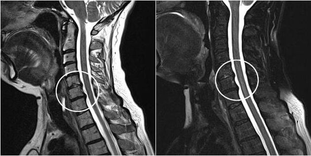 Resonancia magnética da columna cervical con signos de osteocondrose