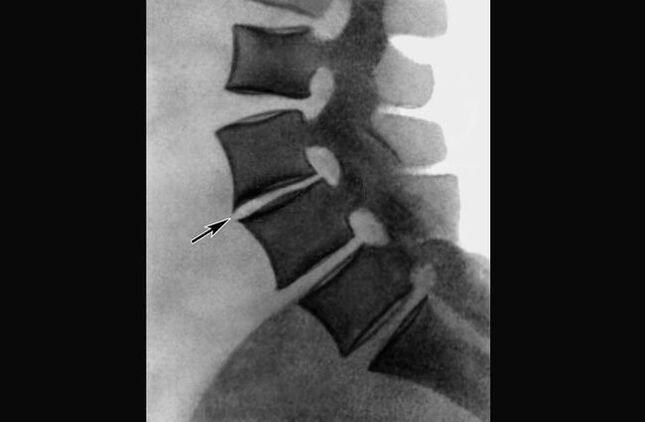 Manifestacións da osteocondrose da columna torácica na imaxe de raios X