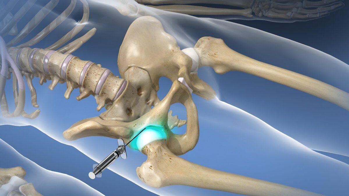 Bloqueo intraarticular para eliminar a dor aguda na coxartrose