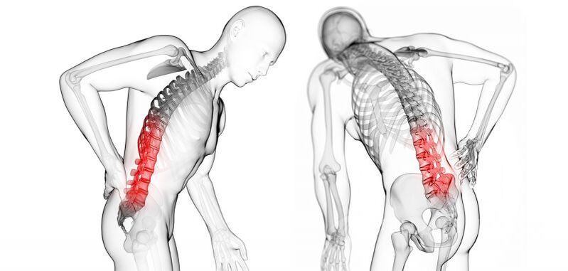 Complicacións da osteocondrose cervical